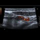 Crohn's disease of terminal ileum: US - Ultrasound