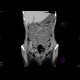 Crohn's disease of terminal ileum, enterography, preoperative: CT - Computed tomography