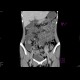 Crohn's disease of terminal ileum, enterography, preoperative: CT - Computed tomography