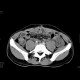 Crohn's disease of the small bowel: CT - Computed tomography