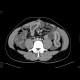 Crohn's disease of the small bowel: CT - Computed tomography