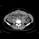 Crohn's disease of the small bowel: CT - Computed tomography