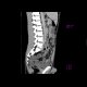 Crohn's disease, intra-abdominal abscess, enterography: CT - Computed tomography