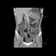 Crohn's disease, intra-abdominal abscess, enterography: CT - Computed tomography