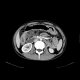 Crohn's disease involving colon, periproctal abscesses, enterography: CT - Computed tomography
