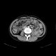 Crohn's disease involving colon, periproctal abscesses, enterography: CT - Computed tomography