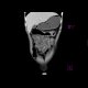 Crohn's disease involving colon, periproctal abscesses, enterography: CT - Computed tomography