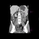 Crohn's disease involving colon, periproctal abscesses, enterography: CT - Computed tomography