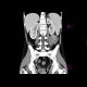 Crohn's disease involving colon, periproctal abscesses, enterography: CT - Computed tomography