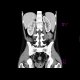 Crohn's disease involving colon, periproctal abscesses, enterography: CT - Computed tomography