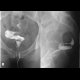 Crohn's disease, periproctal fistula communicating with rectum - fistulography: RF - Fluoroscopy