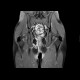 Perianal fistulae, Crohn's disease: MRI - Magnetic Resonance Imaging