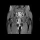 Perianal fistulae, Crohn's disease: MRI - Magnetic Resonance Imaging