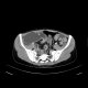 Crohn's disease, chronic ileus due to multiple stenoses, enterography: CT - Computed tomography