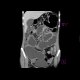 Crohn's disease, chronic ileus due to multiple stenoses, enterography: CT - Computed tomography