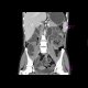 Crohn's disease, chronic ileus due to multiple stenoses, enterography: CT - Computed tomography