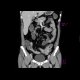 Crohn's disease of small bowel, inflammatory stenosis of the sigmoid colon: CT - Computed tomography