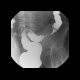 Crohn's disease of small bowel, inflammatory stenosis of the sigmoid colon: RF - Fluoroscopy