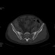 Crohn's disease with absesses, fistulae, and sacroileitis: CT - Computed tomography