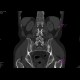 Crohn's disease with absesses, fistulae, and sacroileitis: CT - Computed tomography