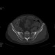 Crohn's disease with absesses, fistulae, and sacroileitis: CT - Computed tomography