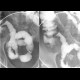 Crohn's disease of ileum: RF - Fluoroscopy