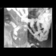 Crohn's disease of ileum: RF - Fluoroscopy