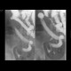 Crohn's disease of ileum: RF - Fluoroscopy