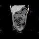 Crohn's disease of ileum: CT - Computed tomography