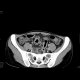 Crohn's disease, extensive involvement of small bowel, fistulae, abscess - Enterography: CT - Computed tomography