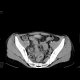 Crohn's disease, extensive involvement of small bowel, fistulae, abscess - Enterography: CT - Computed tomography