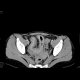 Crohn's disease, extensive involvement of small bowel, fistulae, abscess - Enterography: CT - Computed tomography