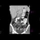 Crohn's disease, extensive involvement of small bowel, fistulae, abscess - Enterography: CT - Computed tomography