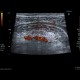 Crohn's disease, acute inflammation, ascites: US - Ultrasound