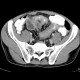 Mesenteric abscess, Crohn's disease: CT - Computed tomography