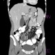 Mesenteric abscess, Crohn's disease: CT - Computed tomography