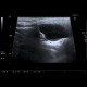 Branchial cleft cyst, parotid gland: US - Ultrasound