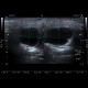 Branchial cleft cyst, parotid gland: US - Ultrasound