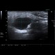 Branchial cleft cyst, parotid gland: US - Ultrasound