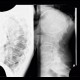 Cyst of a spleen, splenic cyst, calcified: X-ray - Plain radiograph