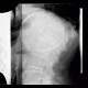Cyst of a spleen, splenic cyst, calcified: X-ray - Plain radiograph