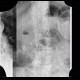 Cyst of a spleen, splenic cyst, calcified: X-ray - Plain radiograph