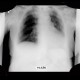 Cyst of a spleen, splenic cyst, calcified: X-ray - Plain radiograph