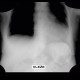 Cyst of a spleen, splenic cyst, calcified: X-ray - Plain radiograph