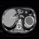 Cyst of a spleen, splenic cyst, calcified: CT - Computed tomography