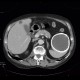 Cyst of a spleen, splenic cyst, calcified: CT - Computed tomography
