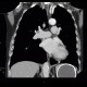 Cyst of a spleen, splenic cyst, calcified: CT - Computed tomography
