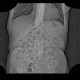 Cyst of a spleen, splenic cyst, calcified: CT - Computed tomography