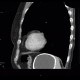 Cyst of a spleen, splenic cyst, calcified: CT - Computed tomography