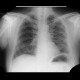 Lymphocytic interstitial pneumonia, cystic lung disease: X-ray - Plain radiograph